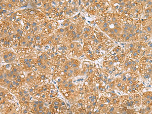 Immunohistochemistry of paraffin-embedded Human liver cancer tissue using PPM1M Polyclonal Antibody at dilution of 1:50 (×200)