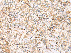 Immunohistochemistry of paraffin-embedded Human liver cancer tissue using FYCO1 Polyclonal Antibody at dilution of 1:60 (×200)