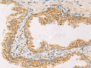 Immunohistochemistry of paraffin-embedded Human prost at e cancer tissue using SUSD3 Polyclonal Antibody at dilution of 1:85 (×200)