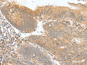 Immunohistochemistry of paraffin-embedded Human colorectal cancer tissue using HHIPL2 Polyclonal Antibody at dilution of 1:50 (×200)