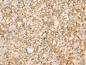 Immunohistochemistry of paraffin-embedded Human liver cancer tissue using PDCL Polyclonal Antibody at dilution of 1:40 (×200)