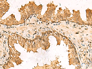 Immunohistochemistry of paraffin-embedded Human prost at e cancer tissue using PDXK Polyclonal Antibody at dilution of 1:75 (×200)