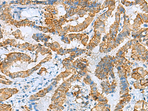 Immunohistochemistry of paraffin-embedded Human thyroid cancer tissue using FBXO8 Polyclonal Antibody at dilution of 1:40 (×200)