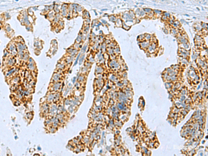 Immunohistochemistry of paraffin-embedded Human gastric cancer tissue using PYCR2 Polyclonal Antibody at dilution of 1:35 (×200)