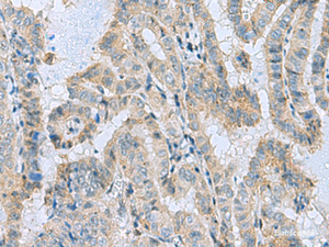 Immunohistochemistry of paraffin-embedded Human thyroid cancer tissue using MGME1 Polyclonal Antibody at dilution of 1:50 (×200)