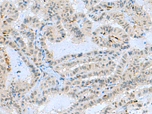 Immunohistochemistry of paraffin-embedded Human thyroid cancer tissue using TCF19 Polyclonal Antibody at dilution of 1:60 (×200)