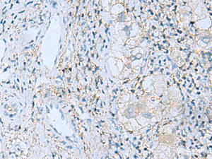 Immunohistochemistry of paraffin-embedded Human liver cancer tissue using EMILIN1 Polyclonal Antibody at dilution of 1:55 (×200)