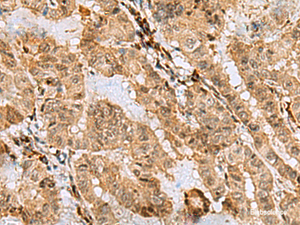 Immunohistochemistry of paraffin-embedded Human thyroid cancer tissue using ASNA1 Polyclonal Antibody at dilution of 1:70 (×200)