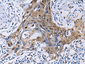 Immunohistochemistry of paraffin-embedded Human esophagus cancer tissue using THOC3 Polyclonal Antibody at dilution of 1:50 (×200)