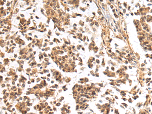 Immunohistochemistry of paraffin-embedded Human breast cancer tissue using NHLRC2 Polyclonal Antibody at dilution of 1:40 (×200)