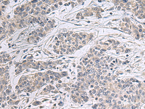 Immunohistochemistry of paraffin-embedded Human colorectal cancer tissue using PPM1K Polyclonal Antibody at dilution of 1:55 (×200)