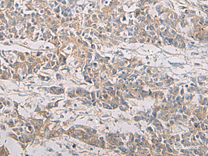Immunohistochemistry of paraffin-embedded Human colorectal cancer tissue using PA2G4 Polyclonal Antibody at dilution of 1:60 (×200)