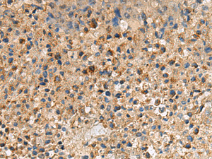 Immunohistochemistry of paraffin-embedded Human liver cancer tissue using CXCR5 Polyclonal Antibody at dilution of 1:60 (×200)