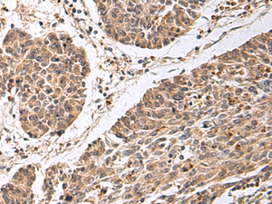 Immunohistochemistry of paraffin-embedded Human colorectal cancer tissue using CD24 Polyclonal Antibody at dilution of 1:25 (×200)