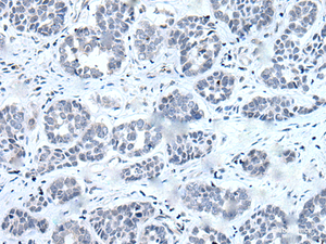 Immunohistochemistry of paraffin-embedded Human esophagus cancer tissue using RARG Polyclonal Antibody at dilution of 1:55 (×200)
