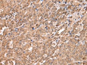 Immunohistochemistry of paraffin-embedded Human ovarian cancer tissue using DDX58 Polyclonal Antibody at dilution of 1:40 (×200)
