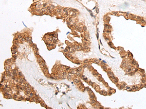 Immunohistochemistry of paraffin-embedded Human thyroid cancer tissue using HOXB9 Polyclonal Antibody at dilution of 1:45 (×200)