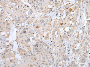 Immunohistochemistry of paraffin-embedded Human esophagus cancer tissue using BORCS8 Polyclonal Antibody at dilution of 1:50 (×200)