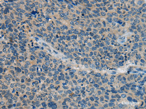 Immunohistochemistry of paraffin-embedded Human cervical cancer tissue using BACE2 Polyclonal Antibody at dilution of 1:45 (×200)