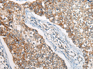 Immunohistochemistry of paraffin-embedded Human lung cancer tissue using BBS12 Polyclonal Antibody at dilution of 1:50 (×200)