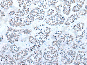 Immunohistochemistry of paraffin-embedded Human esophagus cancer tissue using BRD3 Polyclonal Antibody at dilution of 1:60 (×200)