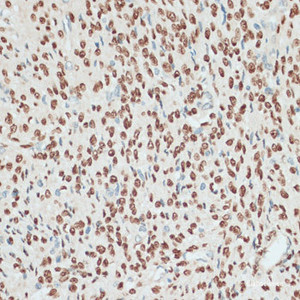 Immunohistochemistry of paraffin-embedded Human uterus using PGR Polyclonal Antibody at dilution of 1:100 (40x lens) .