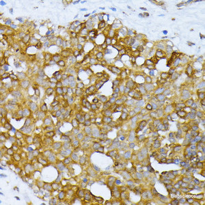 Immunohistochemistry of paraffin-embedded Human breast cancer using ATG7 Polyclonal Antibody at dilution of 1:100 (40x lens) .