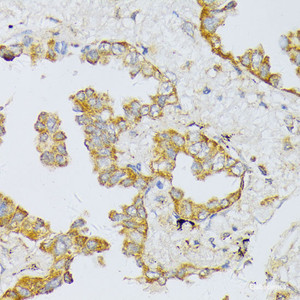 Immunohistochemistry of paraffin-embedded Human lung cancer using ART1 Polyclonal Antibody at dilution of 1:100 (40x lens) .