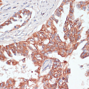 Immunohistochemistry of paraffin-embedded Human lung cancer using TIAM1 Polyclonal Antibody at dilution of 1:100 (40x lens) .