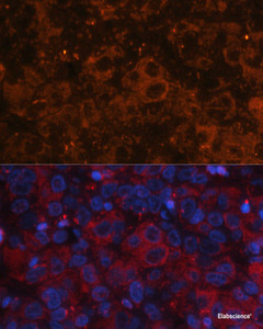 Immunofluorescence analysis of Human liver cancer using AFP Polyclonal Antibody at dilution of 1:100. Blue: DAPI for nuclear staining.