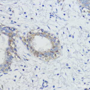 Immunohistochemistry of paraffin-embedded Human mammary cancer using AKT Polyclonal Antibody at dilution of 1:100 (40x lens) .