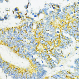 Immunohistochemistry of paraffin-embedded Human colon carcinoma using PD-L1 Polyclonal Antibody at dilution of 1:100 (40x lens) .