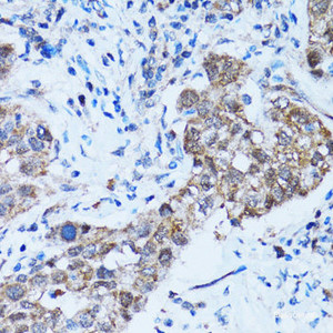 Immunohistochemistry of paraffin-embedded Human lung cancer using Caspase-3 Polyclonal Antibody at dilution of 1:100 (40x lens) .