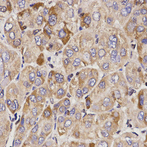 Immunohistochemistry of paraffin-embedded Human liver cancer using GAS2 Polyclonal Antibody at dilution of 1:200 (40x lens) .