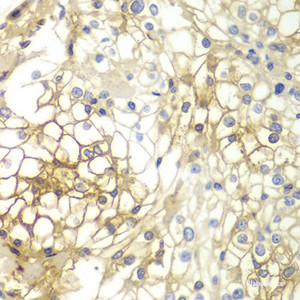 Immunohistochemistry of paraffin-embedded Human kidney cancer using Syndecan-1 Polyclonal Antibody at dilution of 1:200 (40x lens) .