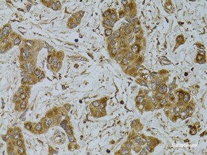 Immunohistochemistry of paraffin-embedded Human liver cancer using TNFSF13 Polyclonal Antibody at dilution of 1:100 (40x lens) .