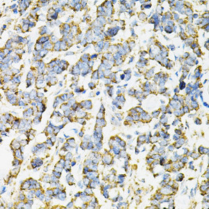 Immunohistochemistry of paraffin-embedded Human lung cancer using ADSS Polyclonal Antibody at dilution of 1:100 (40x lens) .