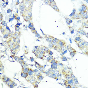 Immunohistochemistry of paraffin-embedded Human mammary cancer using NOD1 Polyclonal Antibody at dilution of 1:100 (40x lens) .