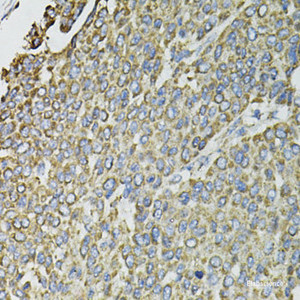 Immunohistochemistry of paraffin-embedded Human liver cancer using RASSF1 Polyclonal Antibody at dilution of 1:100 (40x lens) .