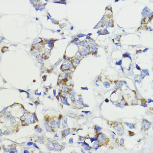 Immunohistochemistry of paraffin-embedded Human mammary cancer using VEGFB Polyclonal Antibody at dilution of 1:200 (40x lens) .