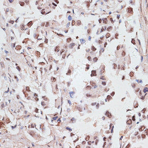 Immunohistochemistry of paraffin-embedded Human lung cancer using DKC1 Polyclonal Antibody at dilution of 1:100 (40x lens) .