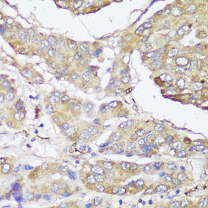 Immunohistochemistry of paraffin-embedded Human liver cancer using FKBP10 Polyclonal Antibody at dilution of 1:150 (40x lens) .