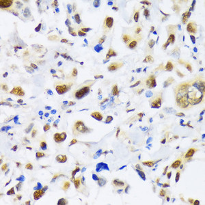 Immunohistochemistry of paraffin-embedded Human lung cancer using EP300 Polyclonal Antibody at dilution of 1:100 (40x lens) .