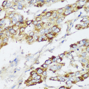 Immunohistochemistry of paraffin-embedded Human liver cancer using ECI2 Polyclonal Antibody at dilution of 1:150 (40x lens) .