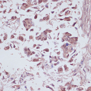 Immunohistochemistry of paraffin-embedded Human lung cancer using U2AF1 Polyclonal Antibody at dilution of 1:100 (40x lens) .