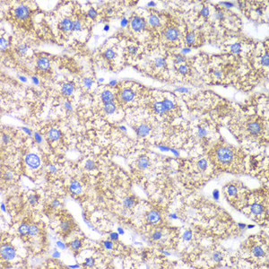 Immunohistochemistry of paraffin-embedded Human liver damage using DLST Polyclonal Antibody at dilution of 1:100 (40x lens) .