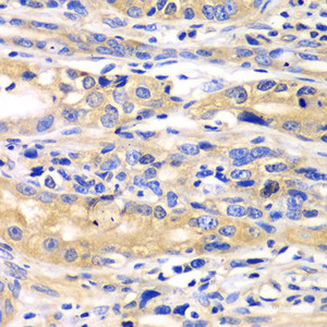 Immunohistochemistry of paraffin-embedded Human gastric cancer using SARS Polyclonal Antibody at dilution of 1:100 (40x lens) .