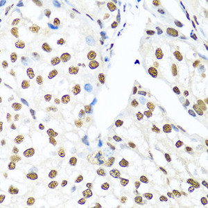 Immunohistochemistry of paraffin-embedded Human prostate cancer using XRCC5 Polyclonal Antibody at dilution of 1:100 (40x lens) .
