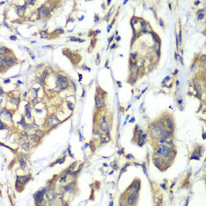 Immunohistochemistry of paraffin-embedded Human liver cancer using NFS1 Polyclonal Antibody at dilution of 1:100 (40x lens) .