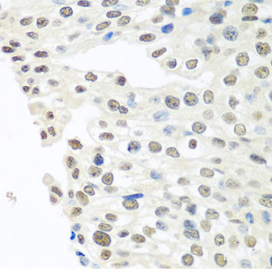 Immunohistochemistry of paraffin-embedded Human prostate cancer using TARDBP Polyclonal Antibody at dilution of 1:100 (40x lens) .